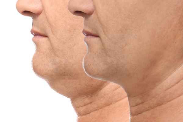 HIFU - Breakthrough in Anti - ageing 2 hifu results Dunstable