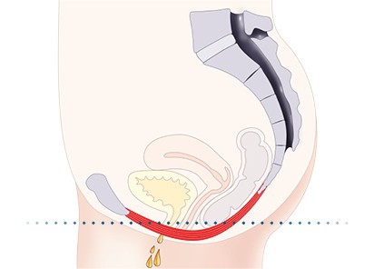 Pelvic-Floor Muscle Repair 5 Pelvic floor muscles Dunstable
