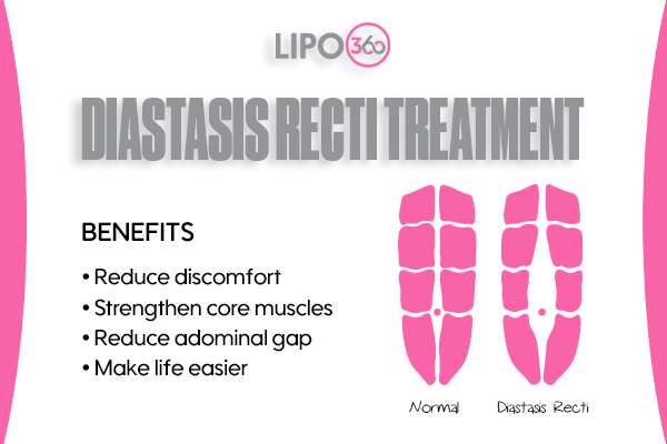 Revolutionising Muscle Repair: The Power of LIPO360 Body Sculpt Post-Injury 5 diastasis recti treatment Dunstable