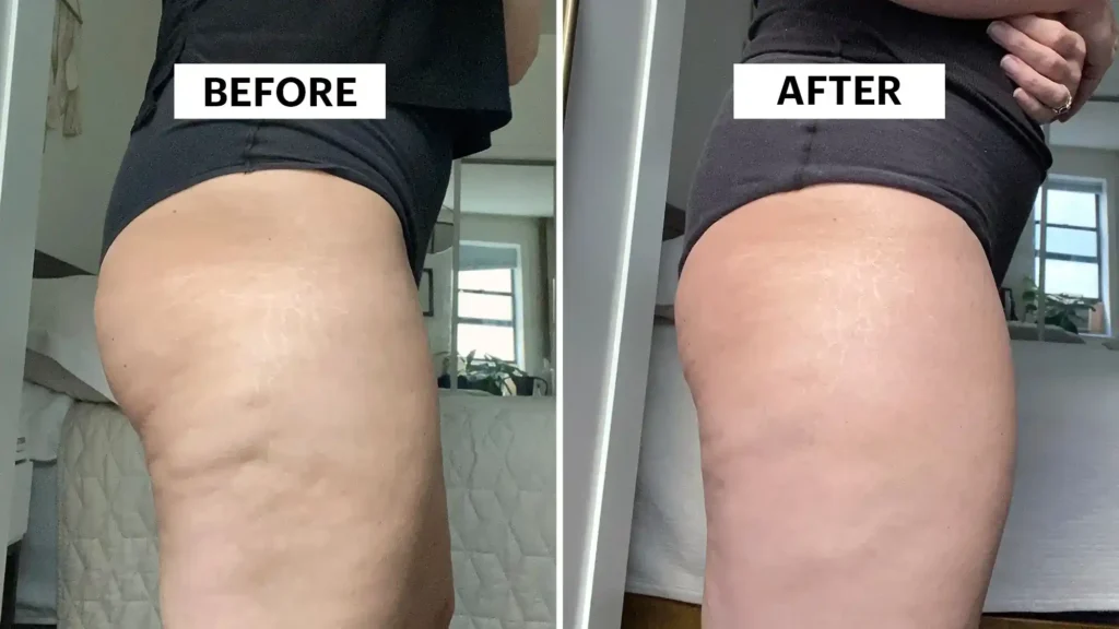 Do Toning Exercise Dunstable Really Tackle Cellulite?