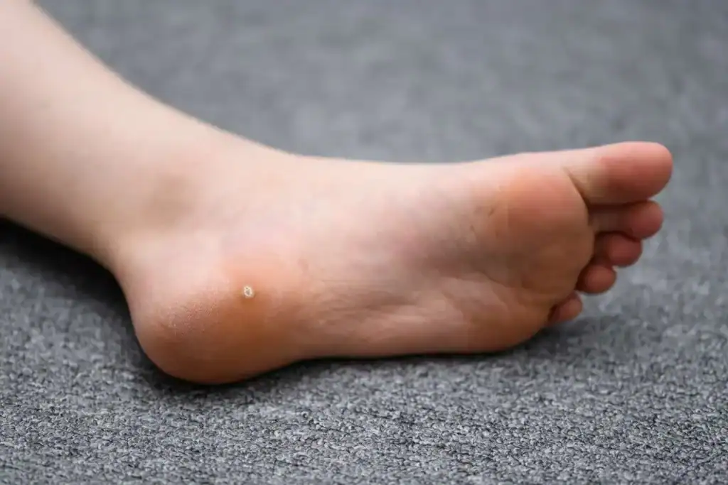Cryotherapy For Warts And Also Verrucas 2 Image of verruca on the bottom of the foot that able to be treated with Cryotherapy Dunstable