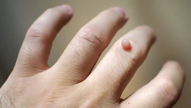 Cryotherapy For Warts And Also Verrucas 1 Image of blemish that Cryotherapy Dunstable can remove with Lipo 360.