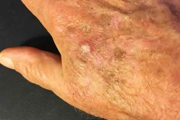 Image of Actinic keratoses Dunstable on a person hand