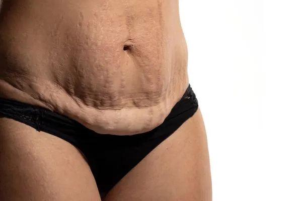 The science behind skin tightening Dunstable picture of a woman's sagging skin on the stomach